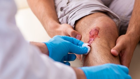 fascitis necrosante