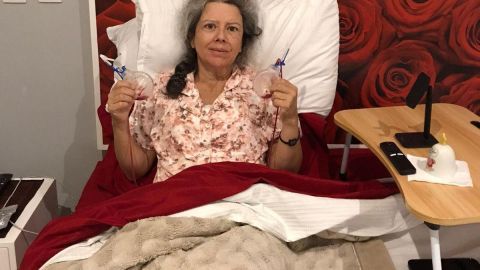 Mercedes Rebollar, muestra los drenes que le pusieron después de la cirugía en la que le retiraron los implantes. (Cortesía)