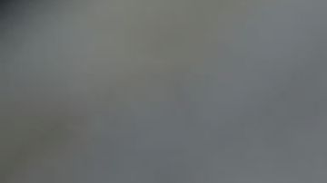 Joven con extraña enfermedad en la piel triunfa en Instagram