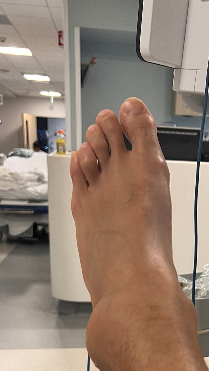 Así se veía el tobillo y pie de Gabriel Coronel después de la lesión en los ensayo de 'Mira Quién Baila All Stars'