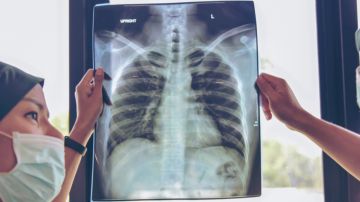 Muertes por tuberculosis aumentan durante la pandemia de COVID-19