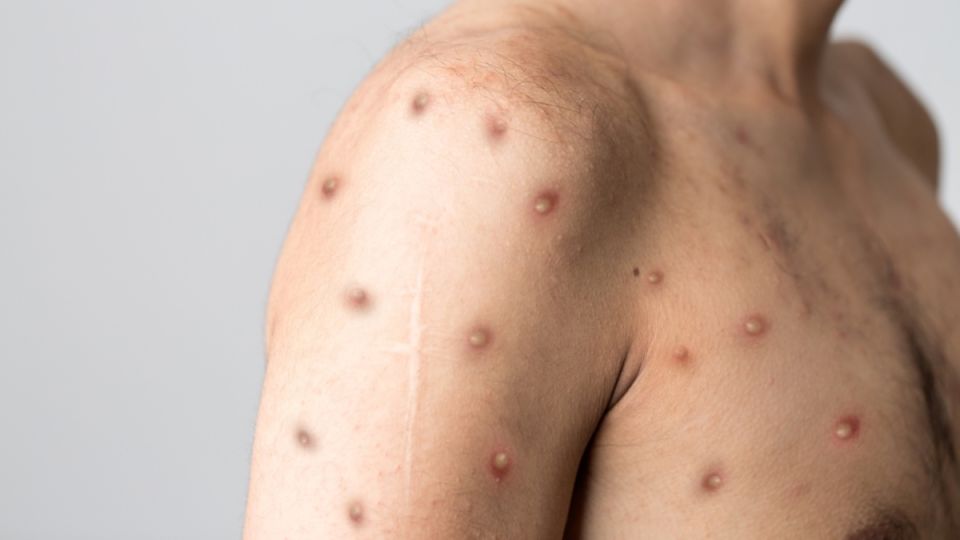Six people with monkeypox have died in the United States