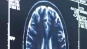 Alzheimer: el medicamento aclamado como un avance trascendental en la lucha contra la enfermedad