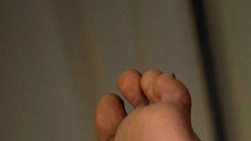 La OMS rebautiza la viruela del mono como "mpox" para evitar estigmatización