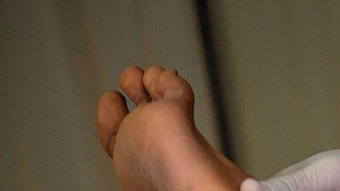 La OMS rebautiza la viruela del mono como "mpox" para evitar estigmatización