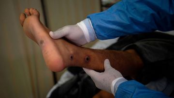 La OMS rebautiza la viruela del mono como "mpox" para evitar estigmatización