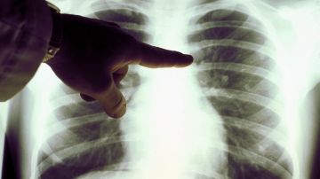 Vista de primer plano de una radiografía de pulmón de un fumador de cigarrillos en una foto sin fecha.