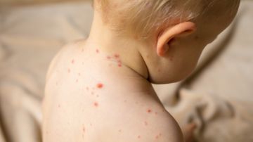 OMS y los CDC alertan que el sarampión es una amenaza mundial