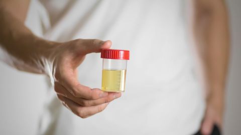 Orina turbia: 5 posibles razones de alarma para ir al médico