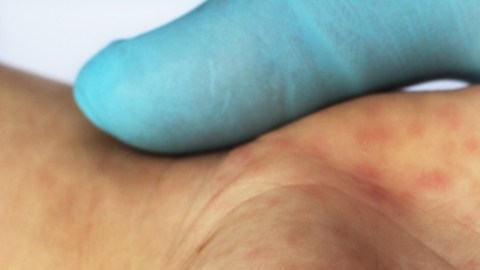 Crece brote de sarampión en Ohio: más de 50 niños están contagiados
