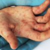 Measles outbreak grows in Ohio: more than 50 children are infected