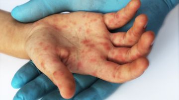 Crece brote de sarampión en Ohio: más de 50 niños están contagiados