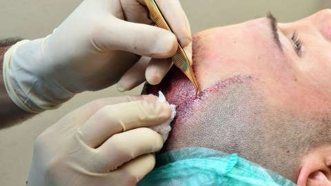 Trasplantes de cabello en India se convierten en un “peligro mortal”