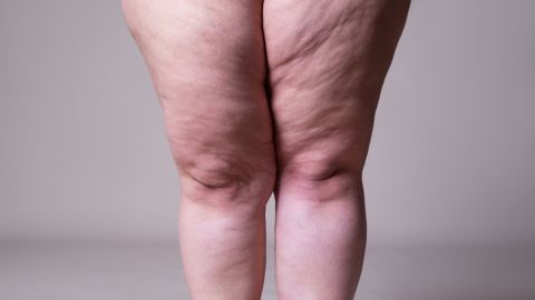 Estados Unidos, en el puesto 15 entre las naciones con más obesidad y sobrepeso del mundo