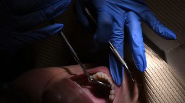 Alertan de cáncer bucal en hombres jóvenes contagios de virus del papiloma humano y mala higiene