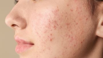 Acné: con qué frecuencia debes lavarte la cara según los dermatólogos