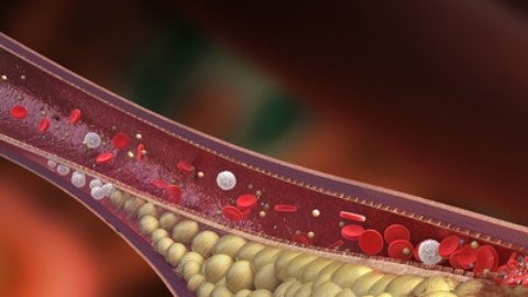 Arterias tapadas: alimentos simples que pueden mejorar la circulación
