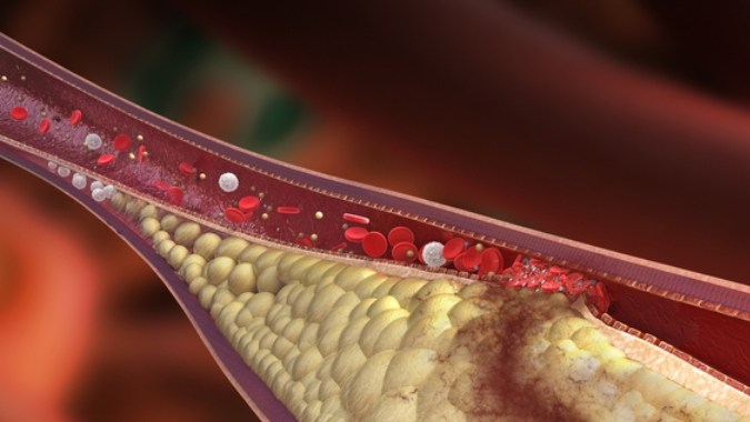 Arterias tapadas: alimentos simples que pueden mejorar la circulación