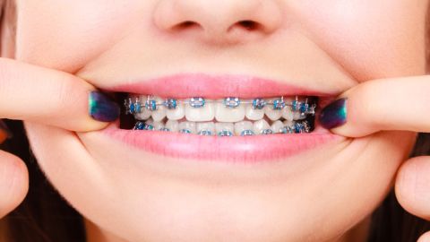 7 señales de que necesitas usar brackets cuanto antes