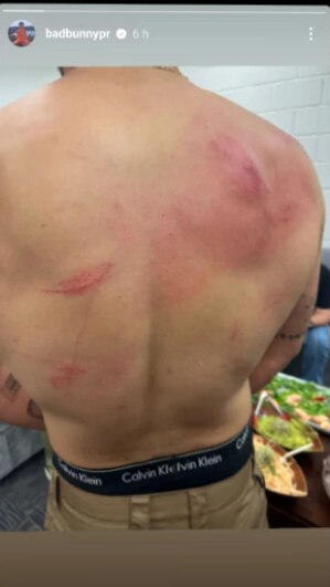 La contienda entre Bad Bunny y Damian Priest durante el WWE Backlash fue todo un espectáculo, pero la pelea le cobró factura al cantante quien compartió una foto donde se ven los golpes y moretones