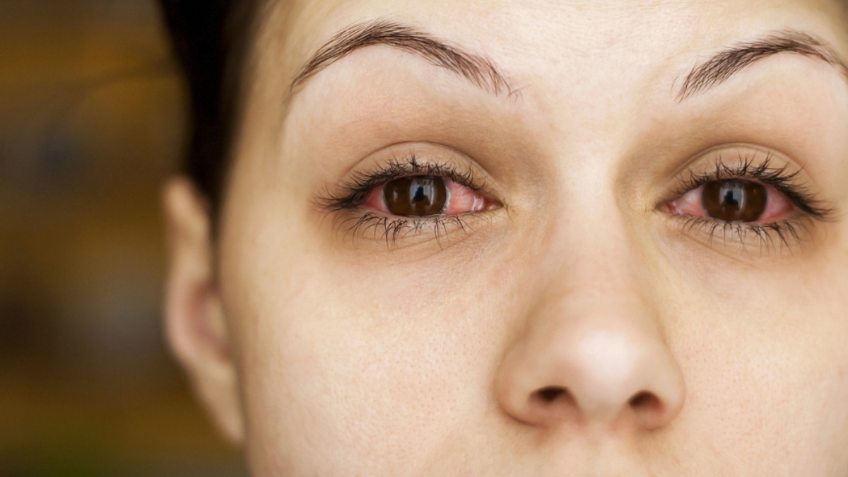 La bacteria vinculada a gotas para ojos es contagiosa entre