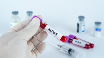 Brote de mpox podría resurgir en EE. UU., dicen los CDC