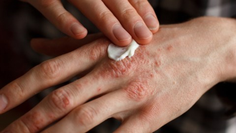 Psoriasis: cómo tu metabolismo influye en la aparición de esta enfermedad