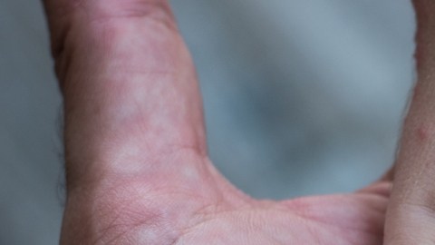 CDC alertan a viajeros internacionales sobre el sarampión: por qué