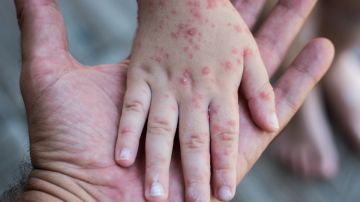 CDC alertan a viajeros internacionales sobre el sarampión: por qué