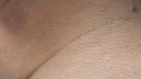 Manchas oscuras en el cuello: lo qué debes saber sobre la acantosis pigmentaria