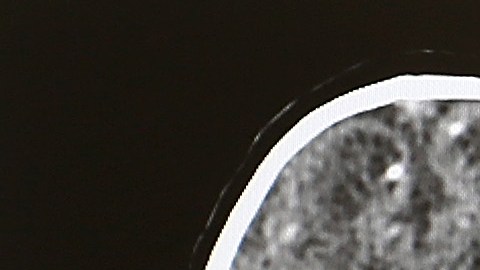 Un adulto murió en Georgia a causa de una rara ameba devoradora de cerebros