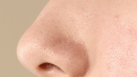 5 nutrientes que pueden ayudarte a prevenir el acné