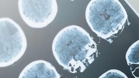 Misteriosa enfermedad cerebral afecta a cientos de jóvenes en Canadá: de qué se trata