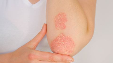 Psoriasis: cómo la deficiencia de vitamina D podría afectar tu piel