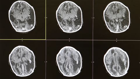 Nadador en Texas murió de una infección causada por una ameba devoradora de cerebros