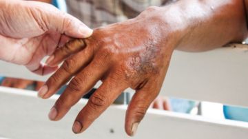 Aumentan casos de lepra en Florida: advierten los CDC