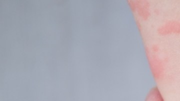 Los niños con eczema podrían necesitar más pruebas de alergia, según studio