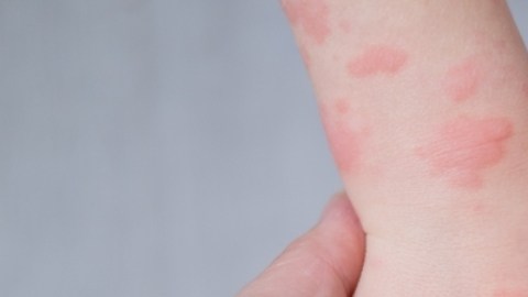 Los niños con eczema podrían necesitar más pruebas de alergia, según studio