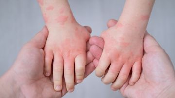 Los niños con eczema podrían necesitar más pruebas de alergia, según studio
