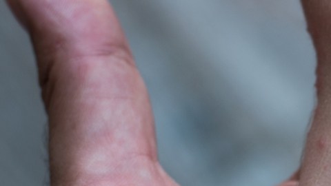 Los casos de sarampión en una provincia de El Congo superan los 1,000 en lo que va de año