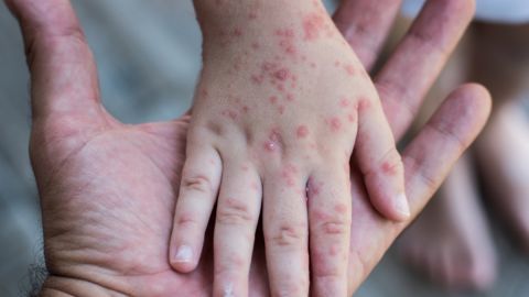Los casos de sarampión en una provincia de El Congo superan los 1,000 en lo que va de año