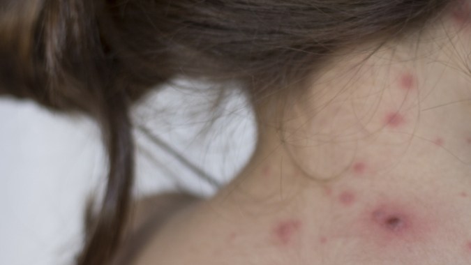 'Clade 9': la nueva variante del virus causante de la varicela detectada en la India