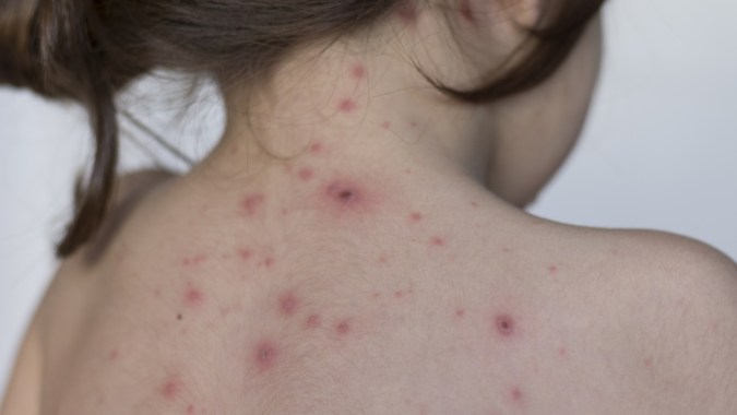 'Clade 9': la nueva variante del virus causante de la varicela detectada en la India