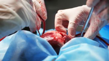 Paciente con transplante de corazón de cerdo marcha favorable a un mes de la cirugía