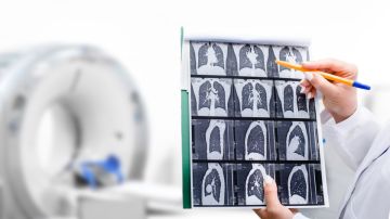 Cáncer de pulmón: cómo una tomografía computarizada puede salvar vidas