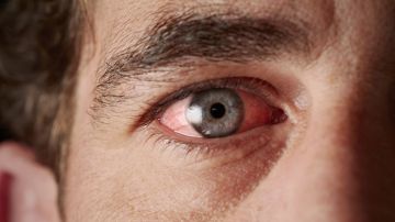 Sífilis ocular: aumenta la preocupación por 5 casos de esta enfermedad en EE.UU.