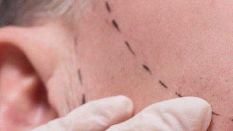 Aaron James recibe el primer transplante de rostro de la historia