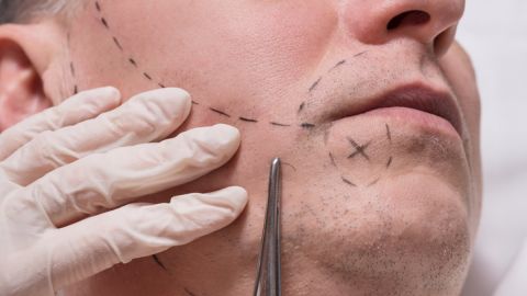 Aaron James recibe el primer transplante de rostro de la historia