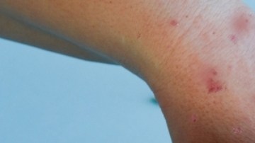 Reino Unido recomienda aplicar la vacuna de varicela en niños