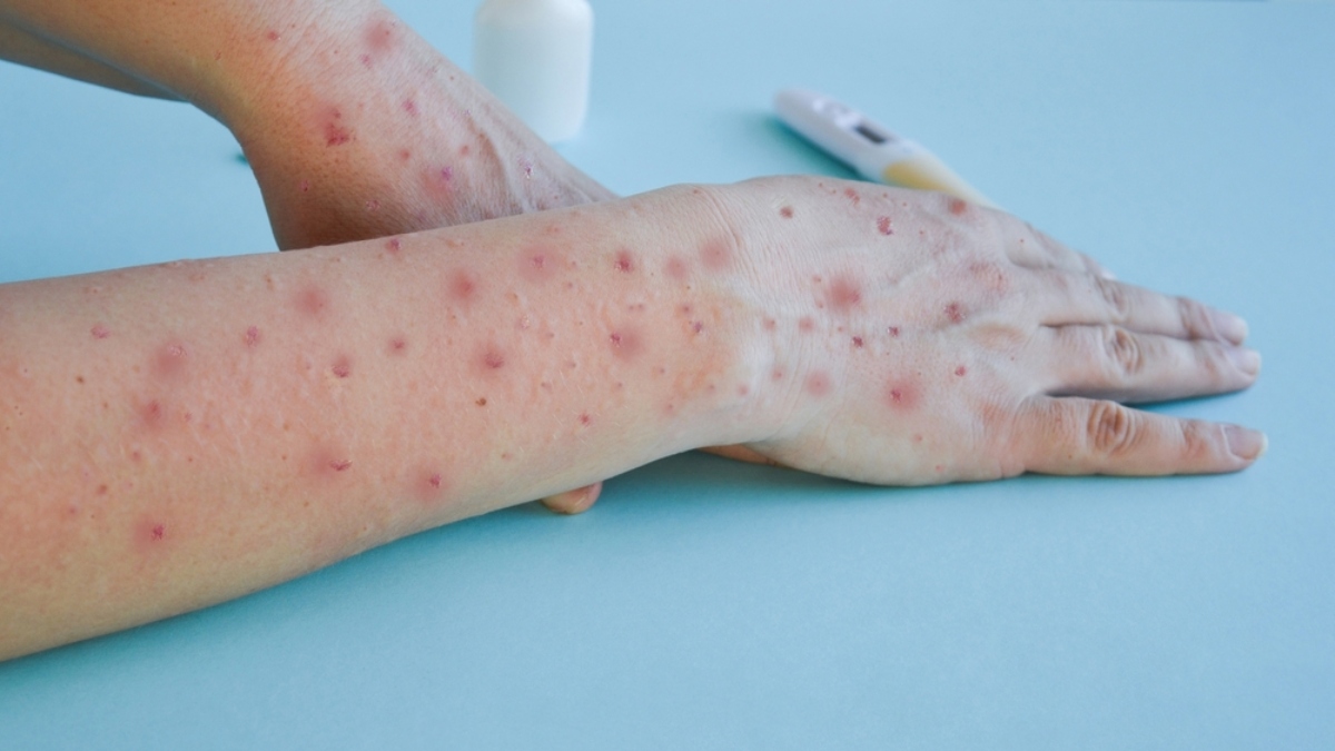 The UK recommends giving children the chickenpox vaccine
